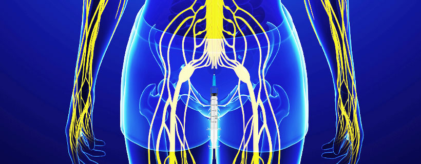 patient receiving Caudal Epidural Steroid Injections in Fort Worth for auto accident injury pain relief