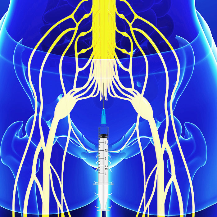 caudal epidural steroid injections in Fort Worth