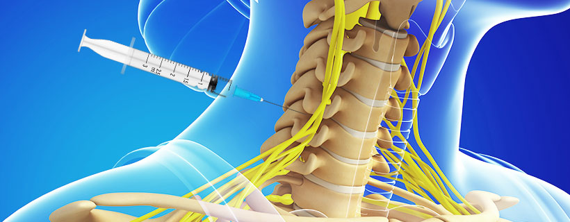 patient receiving Cervical Epidural Steroid Injections in Fort Worth for auto accident injury pain relief