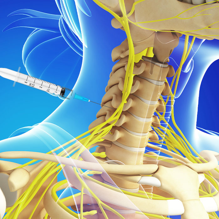 cervical epidural steroid injections in Fort Worth