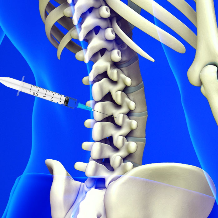 facet joint injections in Fort Worth