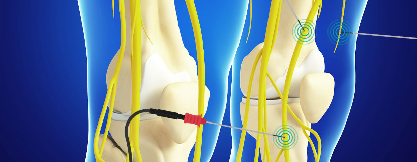 patient receiving Genicular Nerve Ablation in Fort Worth for auto accident injury pain relief
