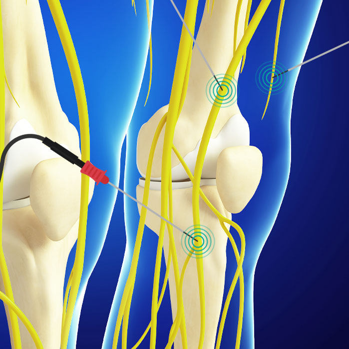 genicular nerve ablation in Fort Worth