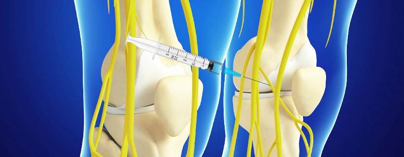 patient receiving Genicular Nerve Block in Fort Worth for auto accident injury pain relief