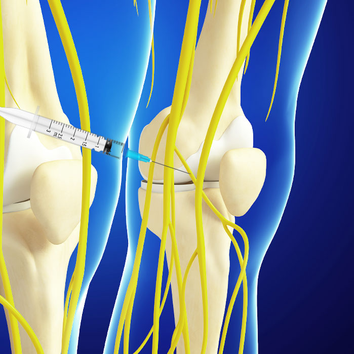 genicular nerve block in Fort Worth