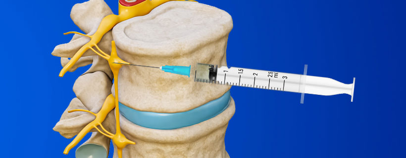 patient receiving Lumbar Sympathetic Block in Fort Worth for auto accident injury pain relief