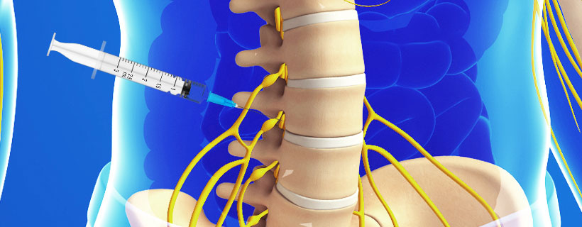 patient receiving Lumbar Transforaminal Epidural Steroid Injections in Fort Worth for auto accident injury pain relief
