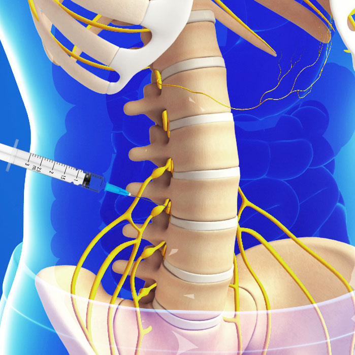 lumbar transforaminal epidural steroid injections in Fort Worth