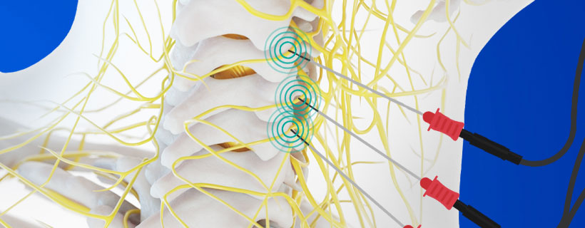 patient receiving Radiofrequency Neurotomy in Fort Worth for auto accident injury pain relief