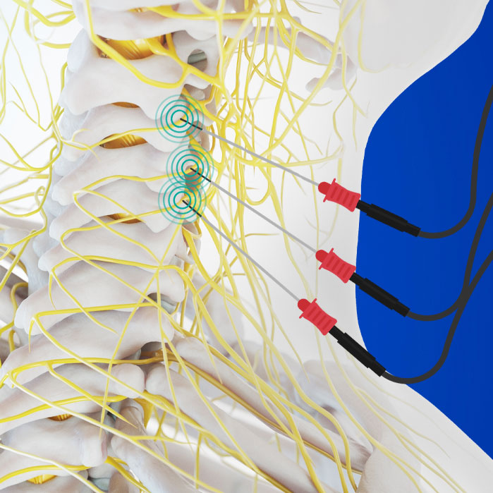 radiofrequency neurotomy in Fort Worth