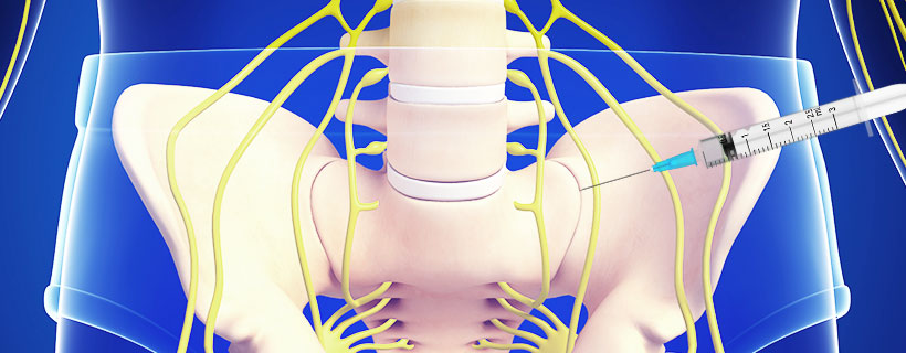 patient receiving Sacroiliac Joint Steroid Injections in Fort Worth for auto accident injury pain relief