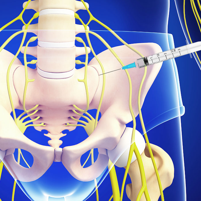 sacroiliac joint steroid injections in Fort Worth
