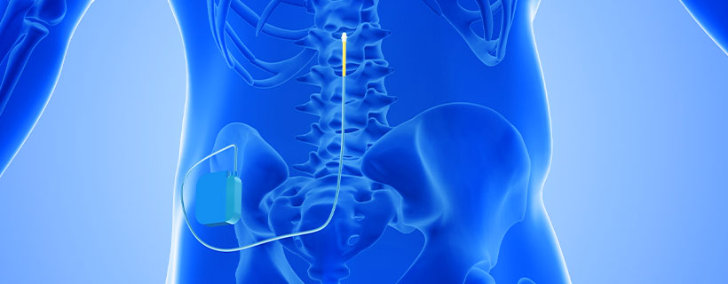 patient receiving Spinal Cord Stimulator Implant in Fort Worth for auto accident injury pain relief