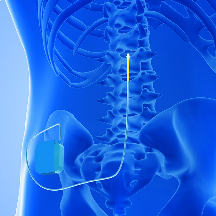 spinal cord stimulator implant in Fort Worth