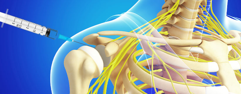 patient receiving Subacromial Injections in Fort Worth for auto accident injury pain relief