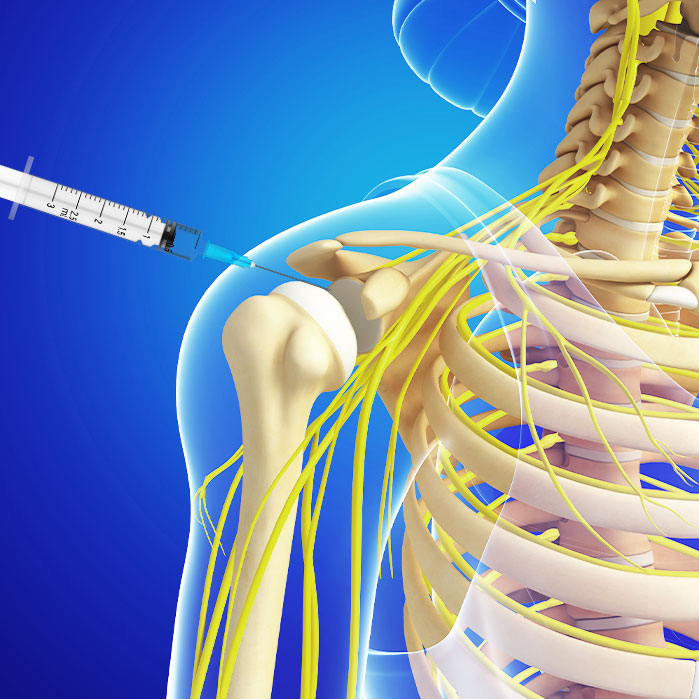 subacromial injections in Fort Worth