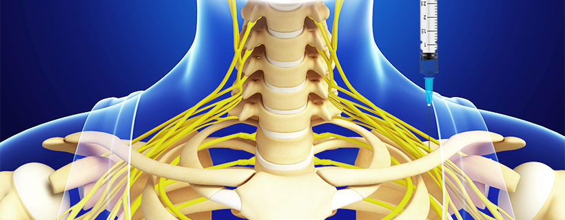 patient receiving Suprascapular Nerve Block in Fort Worth for auto accident injury pain relief