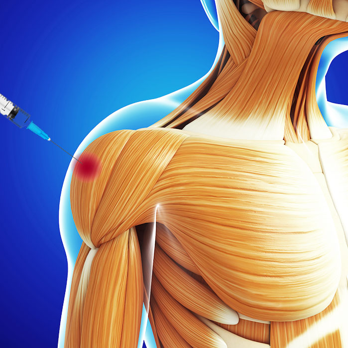 trigger point injections in Fort Worth