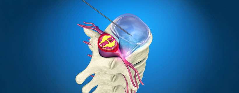 patient receiving YESS Endoscopic Discectomy in Fort Worth for auto accident injury pain relief