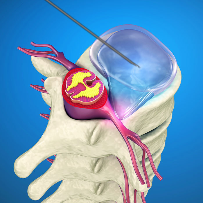 yess endoscopic discectomy in Fort Worth